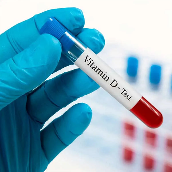 25-Hydroxy Vitamin D Test