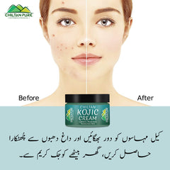 Kojic Cream – Affordable and quality body lotion cream, prevents hyperpigmentation, fades dark spots, treats melasma, minimizes discoloration – 100% pure organic 50ml - Mamasjan