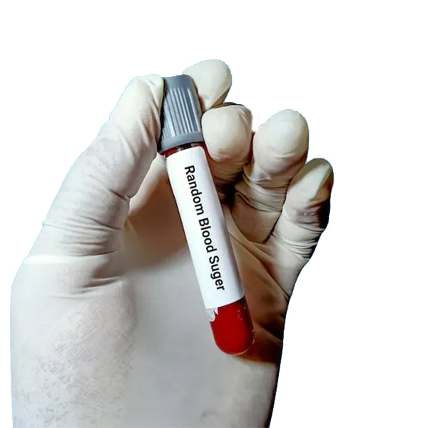 Rbs (Glucose Random) Test