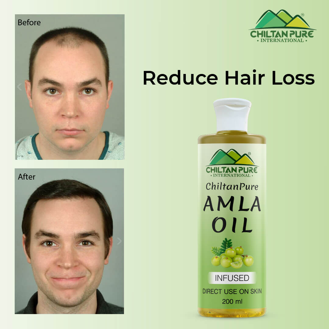 Amla Oil – Lessen Hair Loss, Boosts Hair Growth, Treats Dry Scalp & Prevents Premature Hair Greying - Mamasjan