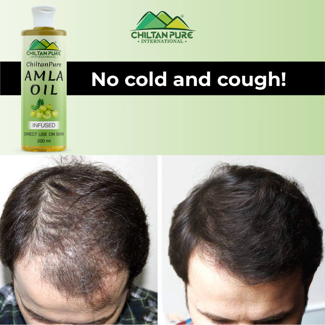 Amla Oil – Lessen Hair Loss, Boosts Hair Growth, Treats Dry Scalp & Prevents Premature Hair Greying - Mamasjan