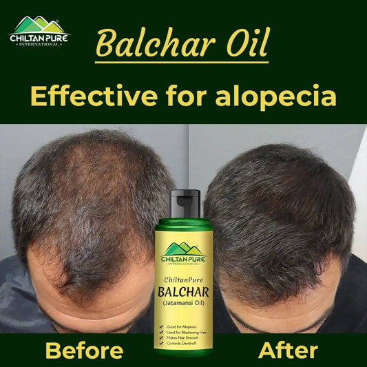 Balchar (Jatamansi) Oil – Effective for Alopecia, Enlarges Follicular Hair Size & Prevents Scalp Infections - Mamasjan