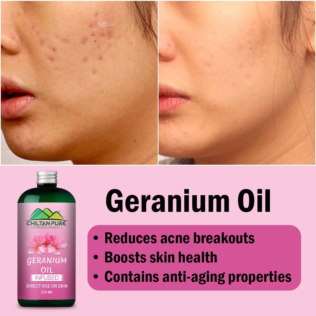 Geranium Oil – Relax with sweet aroma – Contains anti-bacterial & anti-microbial properties, Reduces acne breakouts, cure skin infections – pure organic [Infused] - Mamasjan