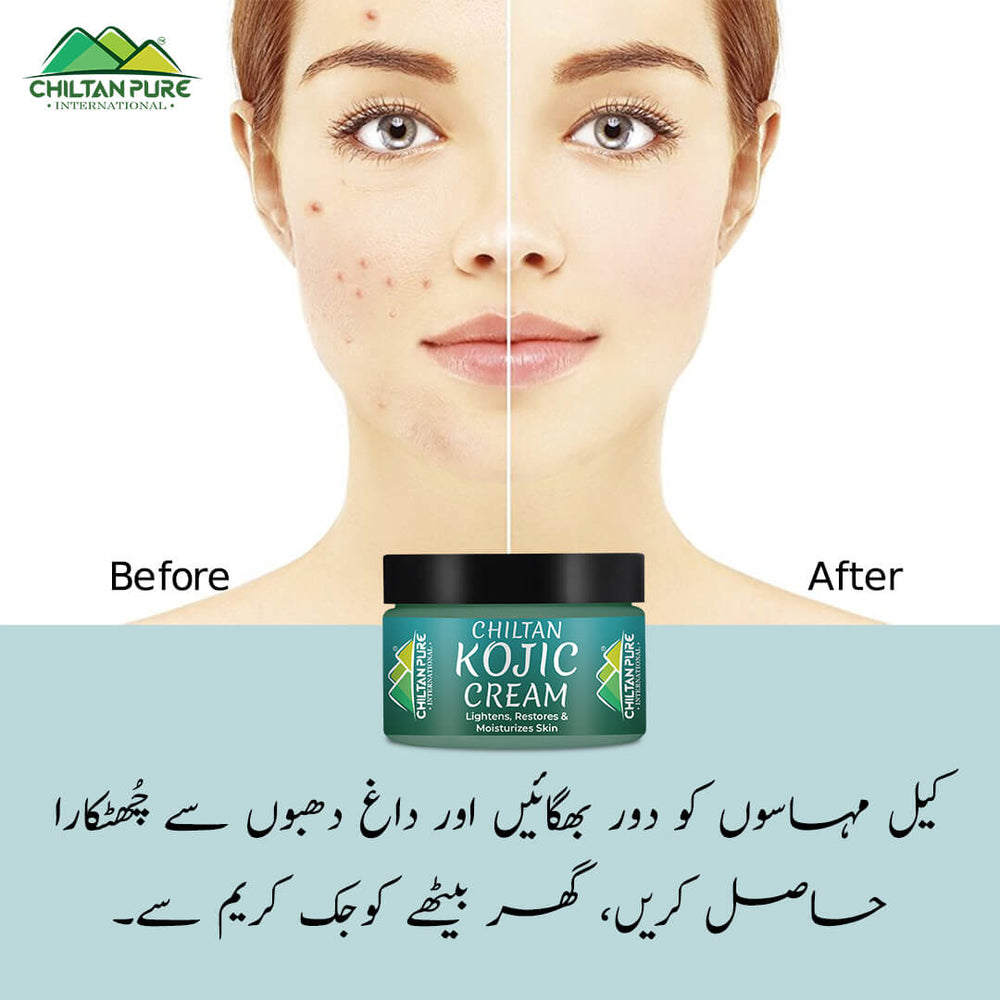 Kojic Cream – Affordable and quality body lotion cream, prevents hyperpigmentation, fades dark spots, treats melasma, minimizes discoloration – 100% pure organic 50ml - Mamasjan