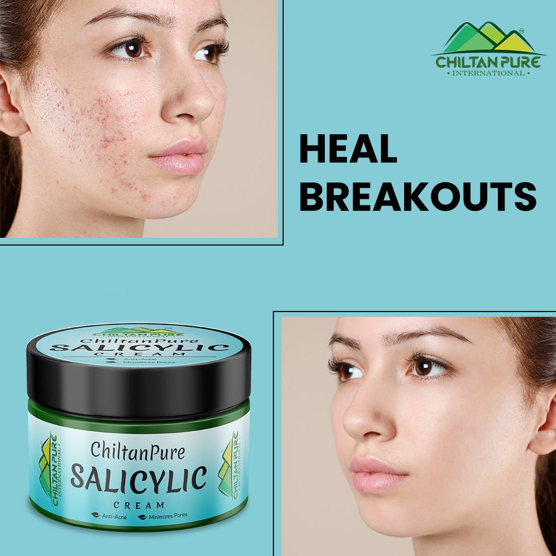 Salicylic Cream – Exfoliates Skin, Anti-Acne, Lighten Acne Scars, Makes Skin Healthy & Glowing - Mamasjan