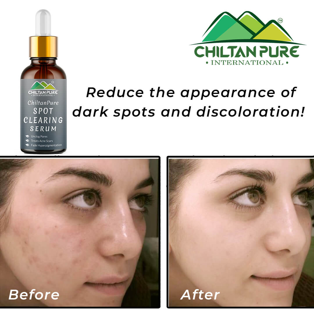 Spot Clearing Serum – Unclog Pores, Reduce Dark Spots & Fade Hyperpigmentation - Mamasjan