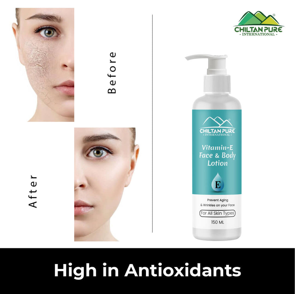 Vitamin-E Lotion - Used as a Moisturizer To Treat or Prevent Dry, Rough, Scaly, Itchy Skin &amp; Minor Skin Irritations (e.g., Diaper rash, Skin Burns From Radiation Therapy) - Mamasjan