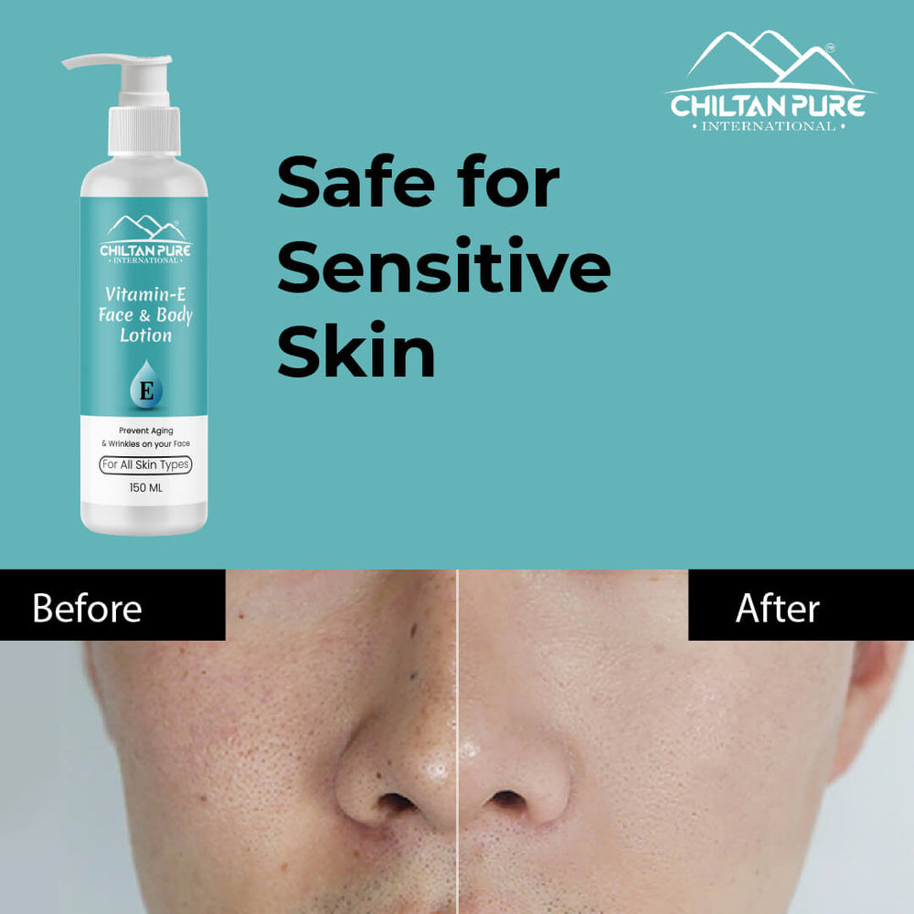 Vitamin-E Lotion - Used as a Moisturizer To Treat or Prevent Dry, Rough, Scaly, Itchy Skin &amp; Minor Skin Irritations (e.g., Diaper rash, Skin Burns From Radiation Therapy) - Mamasjan